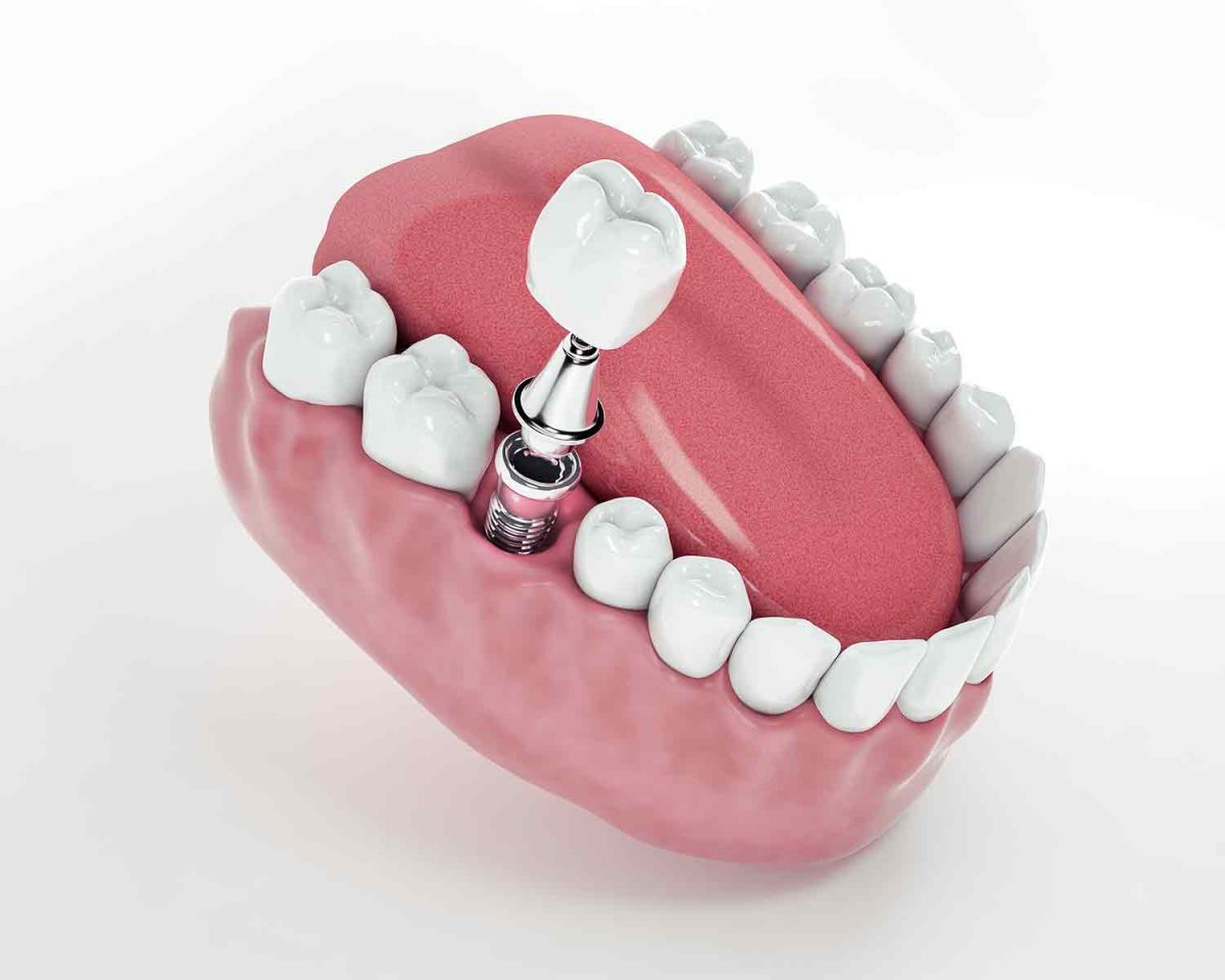 implant2-samsun