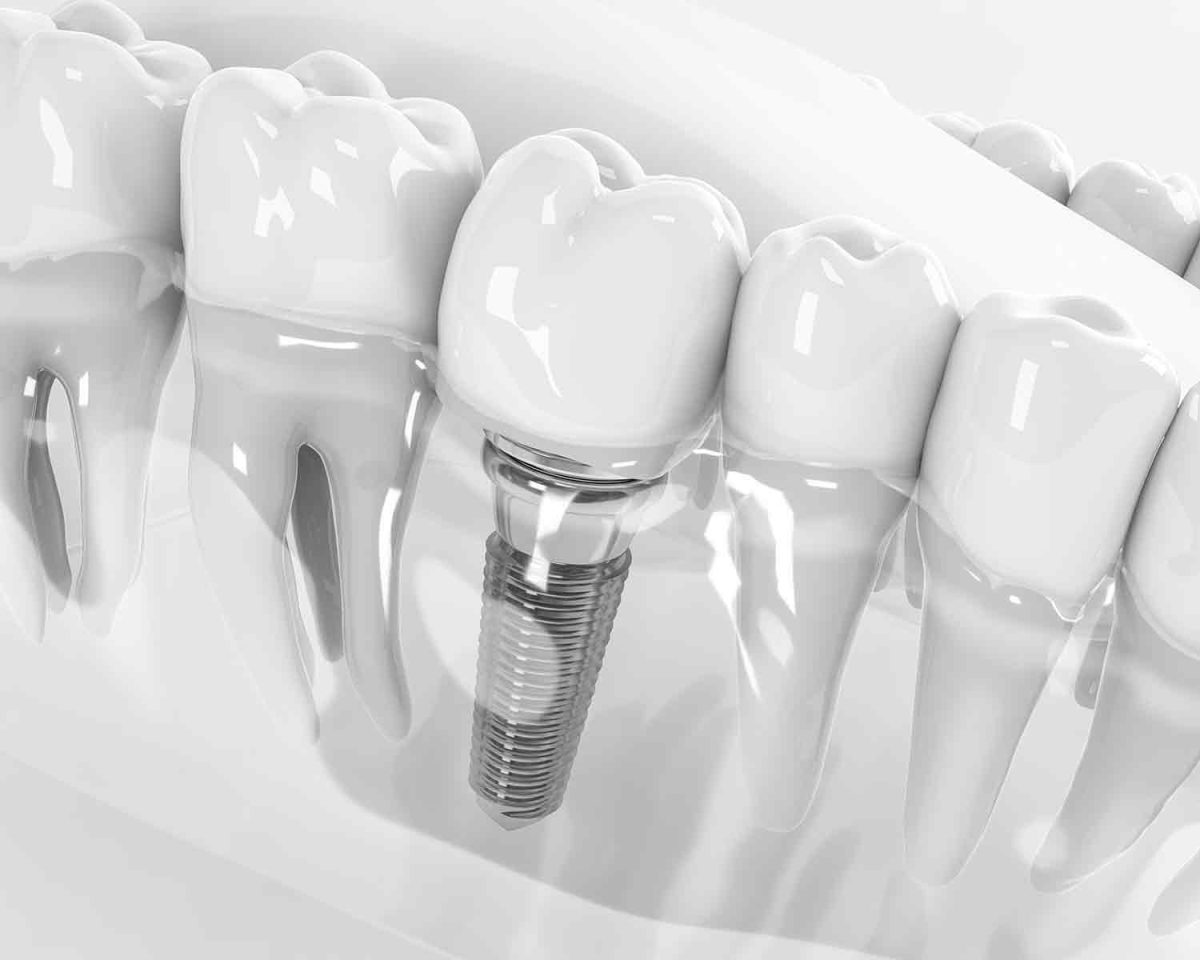 implant3-samsun