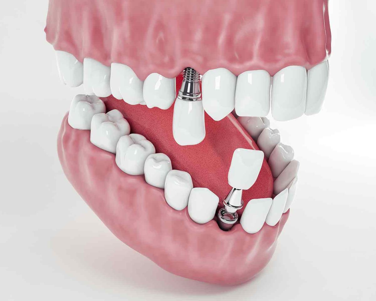 implant5-samsun